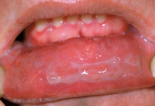Pemphigus